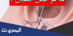 ما هو قص العجان