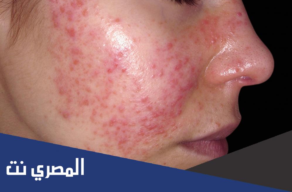 ما هو مرض الذئبة الحمراء