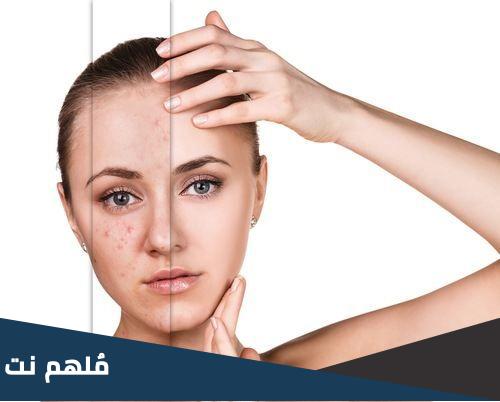 ما هو الفراكشنال ليزر