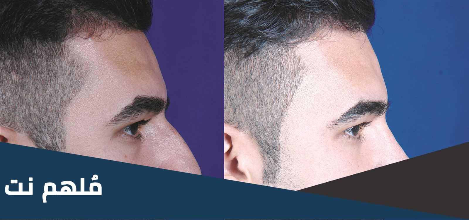 كم تكلف عملية زراعة الشعر في الكويت
