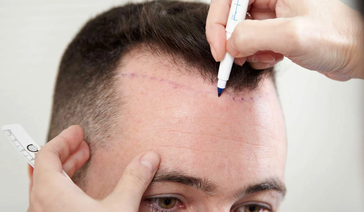 كم تكلفة زراعة الشعر في المغرب