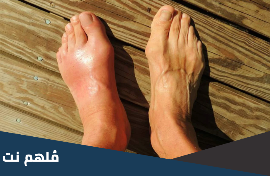 ماهو المرض الذي يطلق عليه داء الملوك