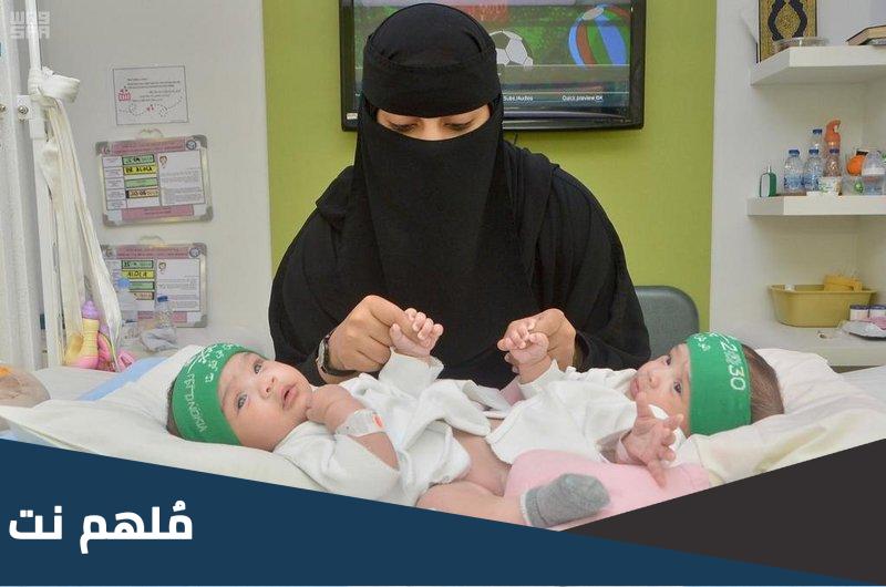 كم عدد عمليات فصل التوائم في السعودية