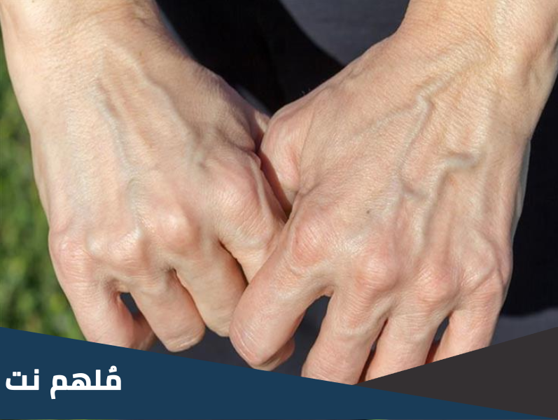 لماذا تظهر عروق بعض الناس من الجلد وتختفي