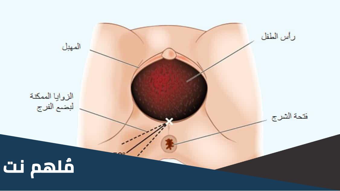 ماذا يعني قص العجان